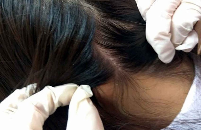 Chữa trị nấm da đầu bằng phương pháp dân gian an toàn, hiệu quả