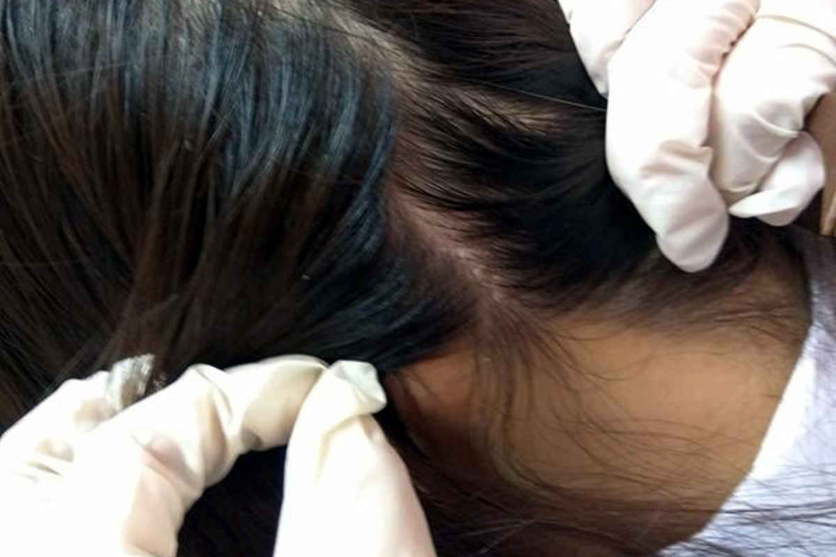 Chữa trị nấm da đầu bằng phương pháp dân gian an toàn, hiệu quả