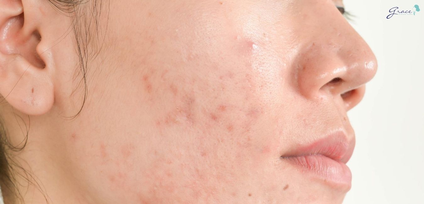 Kinh nghiệm chăm sóc da mặt bị mụn mà bạn không thể bỏ qua