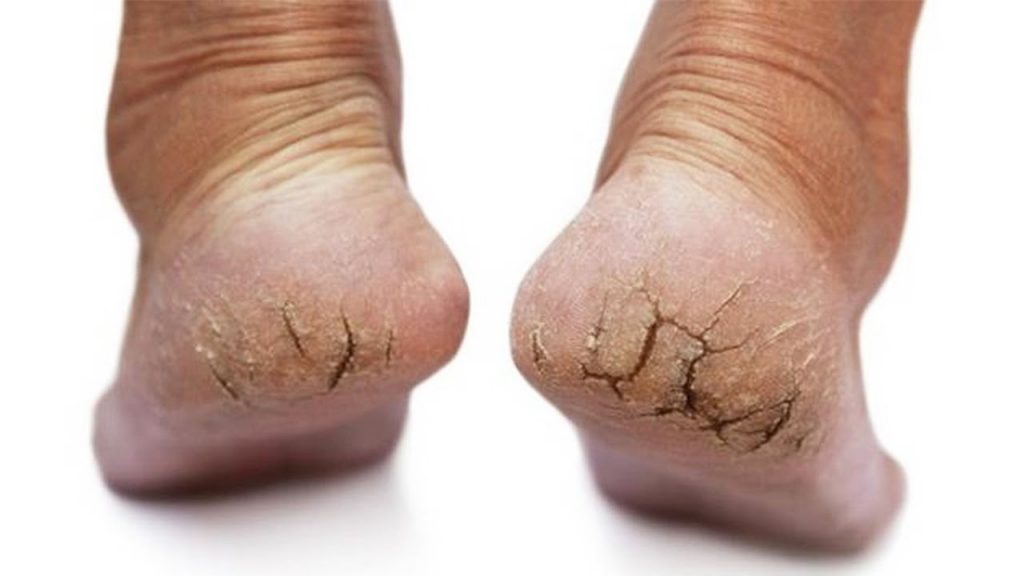 Phương pháp chăm sóc da chân bị khô cứng, nhất là mùa đông