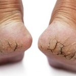 Phương pháp chăm sóc da chân bị khô cứng, nhất là mùa đông