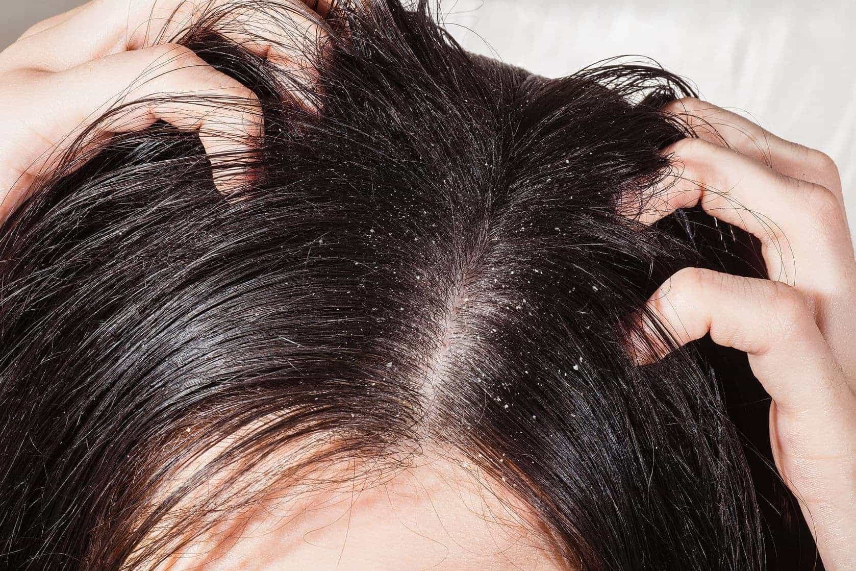 Phương pháp trị gàu và ngứa da đầu ngăn rụng tóc hiệu quả tại nhà